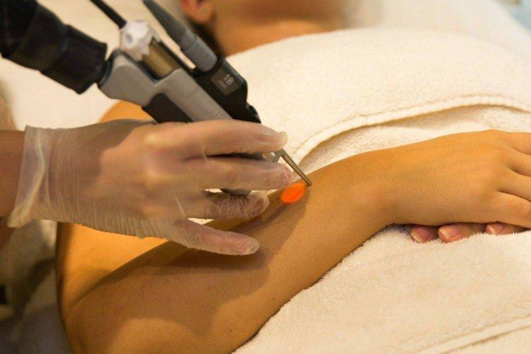 Неодимовый лазер