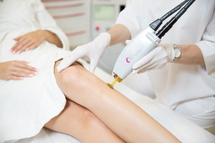 Александритовый лазер