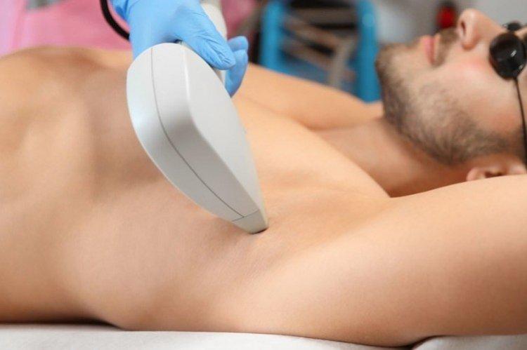 Подходит ли лазерная эпиляция мужчинам?