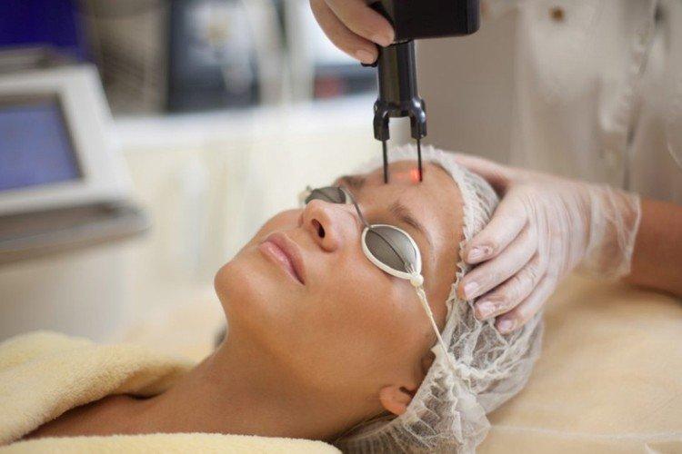 Лазерный пилинг лица