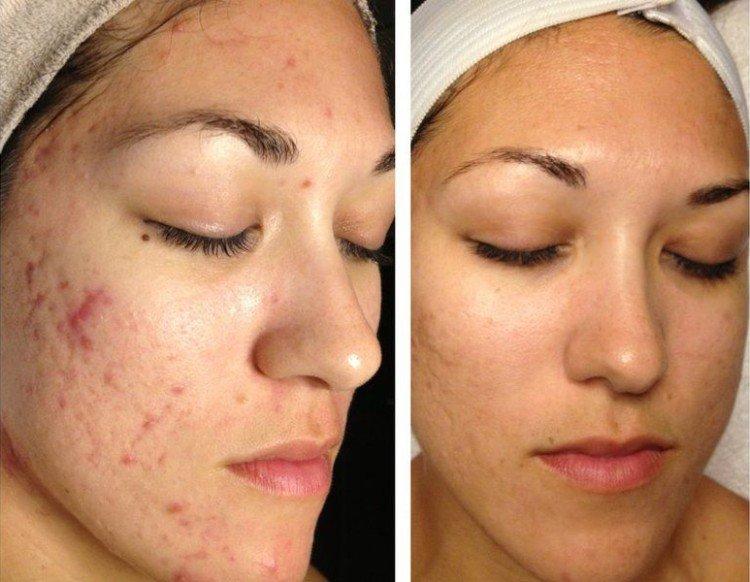 Пилинг лица - фото до и после