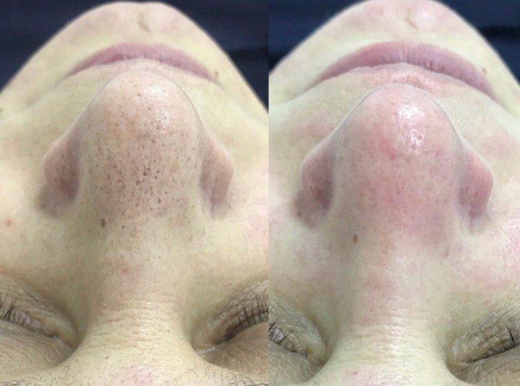 Ультразвуковая чистка лица - фото до и после