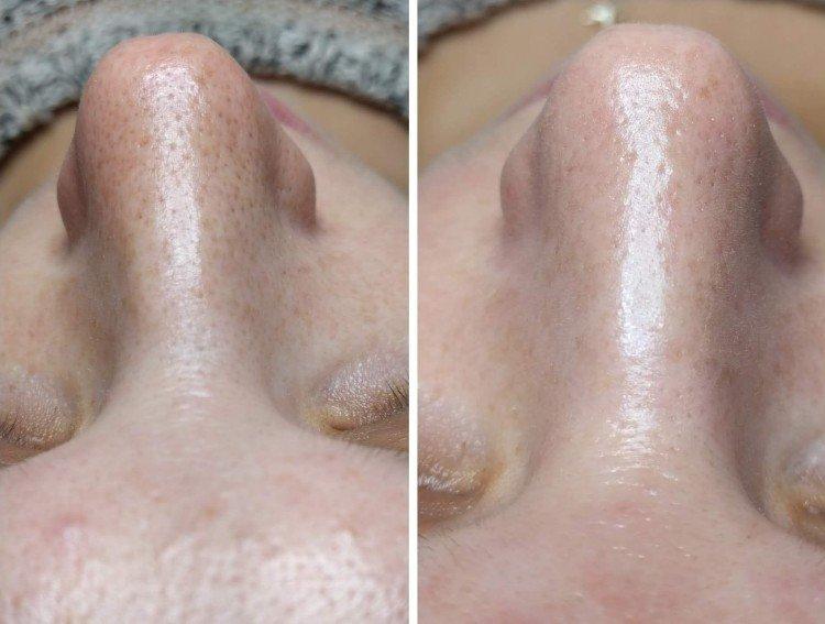 Ультразвуковая чистка лица - фото до и после