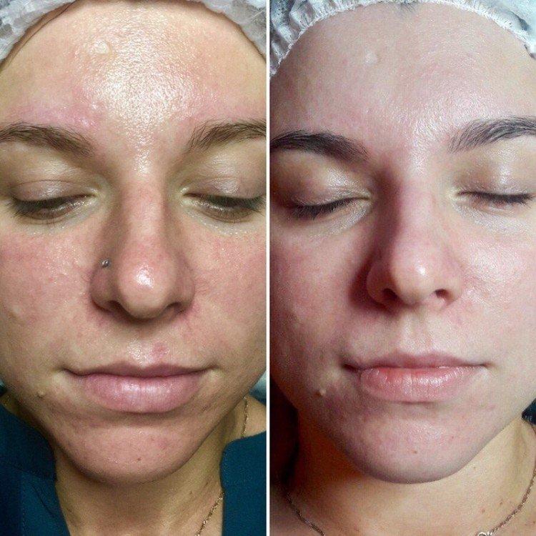 Ультразвуковая чистка лица - фото до и после